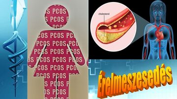 Érelmeszesedés PCOS-ben és ezek következményei